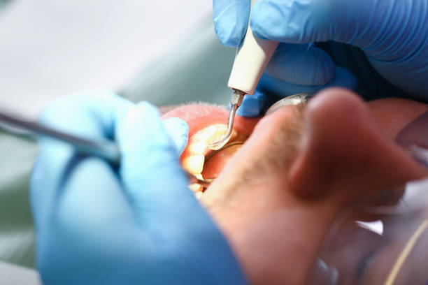 Best Knocked-Out Tooth (Avulsed Tooth) Treatment in Luverne, MN